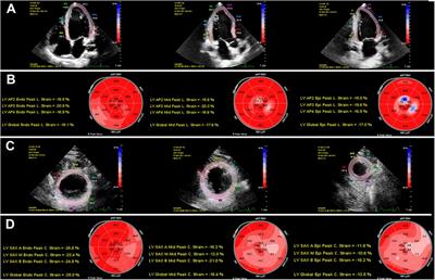 Association between myocardial layer-specific strain and high 10-year risk of atherosclerotic cardiovascular disease in hypertension—findings from the China-PAR project study